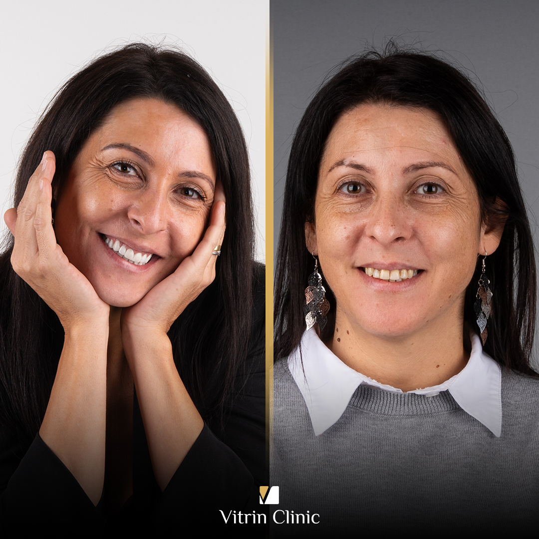 What Is Dental Occlusion? Types, Bite Problems, Assessment, and Treatment